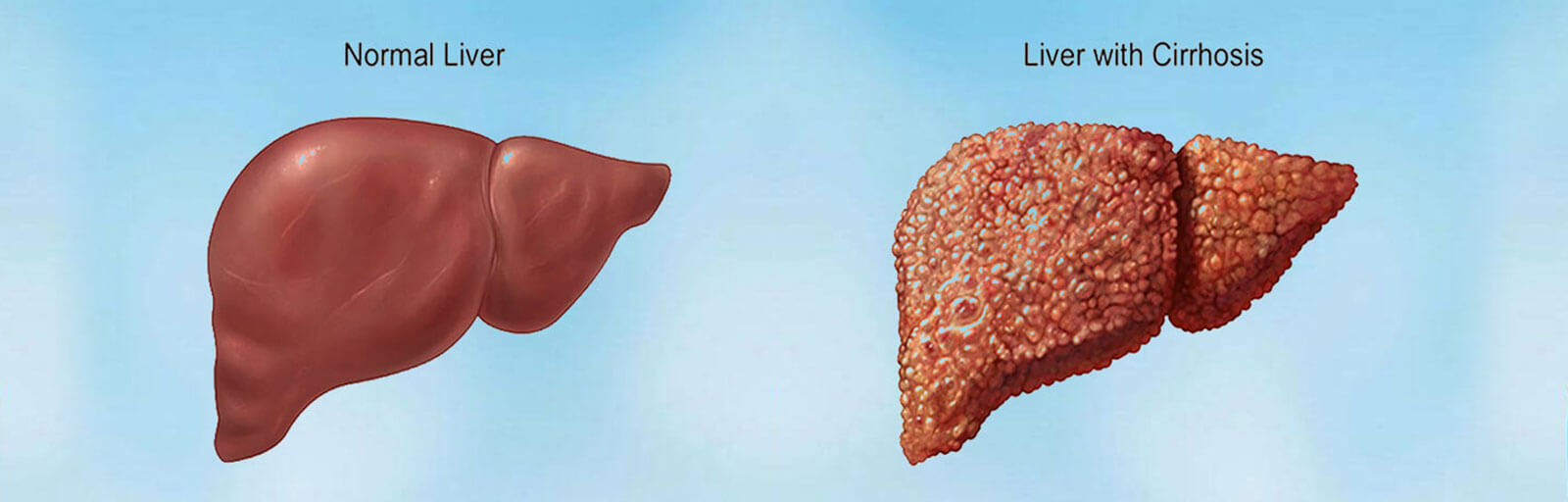 Hepatic disease liver cirrhosis